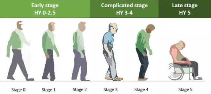Stages in Parkinson's disease